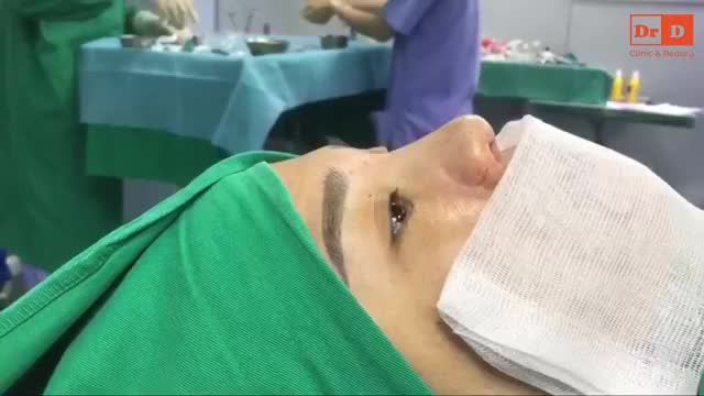 Nâng mũi Sline - mềm mại, tự nhiên, cao vừa phải, phù hợp với nhu cầu của khách hàng.