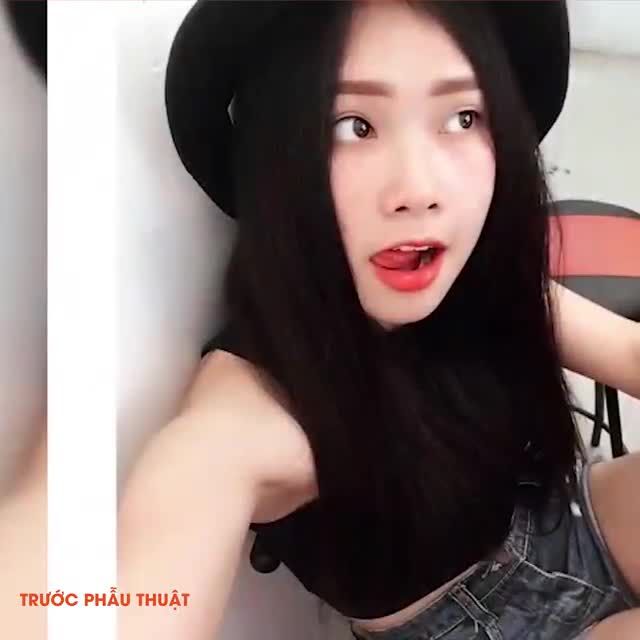 Nâng mũi Sline Surgiform - Đẹp hiện đại, sang chảnh.
