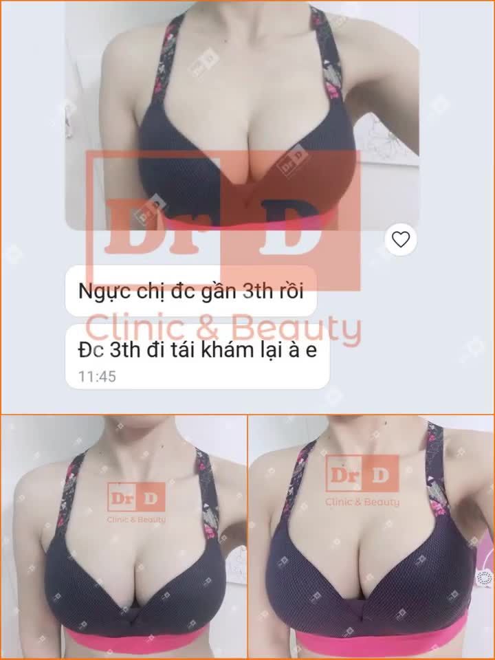 Nâng ngực Thẩm mỹ DrD - Đẹp tự nhiên, vạn người mê.