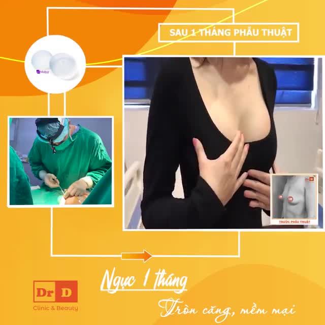 Ngực 1 tháng - Tròn căng mềm mại.