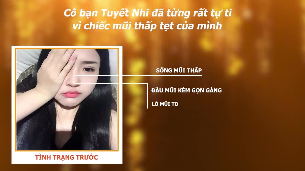 Thay dáng mũi - Nâng tầm nhan sắc.