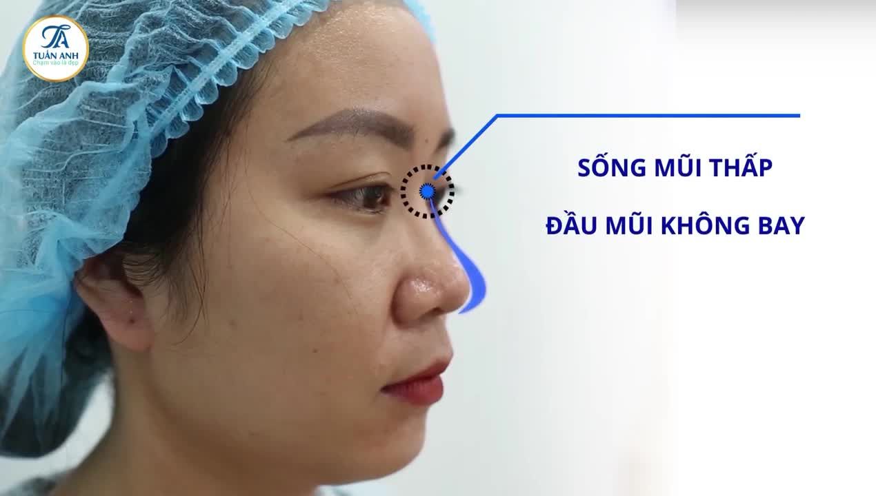 CẬN CẢNH QUÁ TRÌNH NÂNG MŨI BÁN CẤU TRÚC