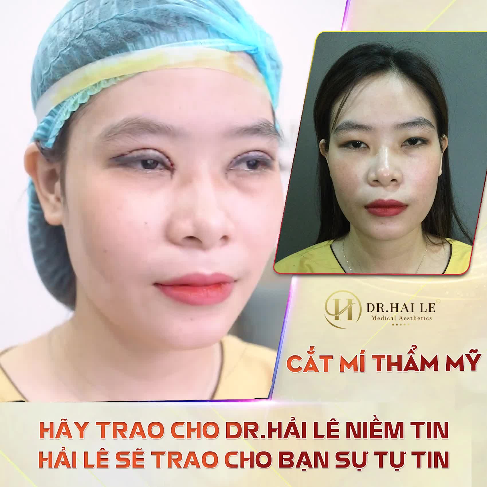 CẮT MÍ THẨM MỸ - DR.HẢI LÊ SỐ 1 CẮT MÍ MẮT!