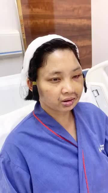 Theo dõi kết quả ca phẫu thuật mặt liệt mức độ nghiêm trọng tại Kangnam Hà Nội