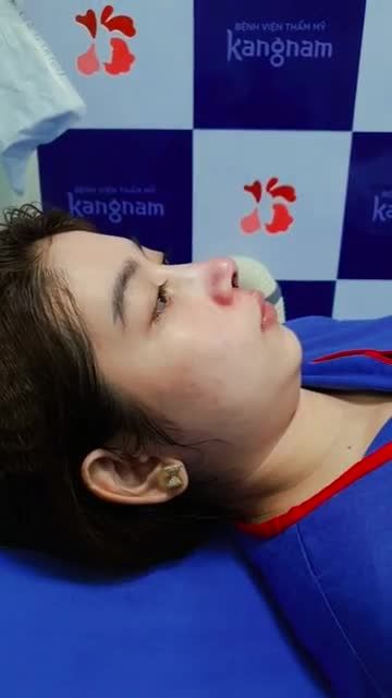 Dáng mũi thon dài với dịch vụ nâng mũi tại bvtm kangnam sài gòn