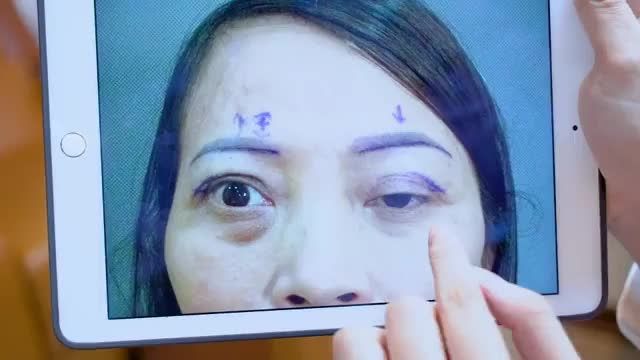 Mí lỗi hỏng đứt cơ nâng mi được Dr.Hải Lê Top 1 sửa mí giải cứu thành công như thế nào? Lắng nghe người trong cuộc chia sẻ