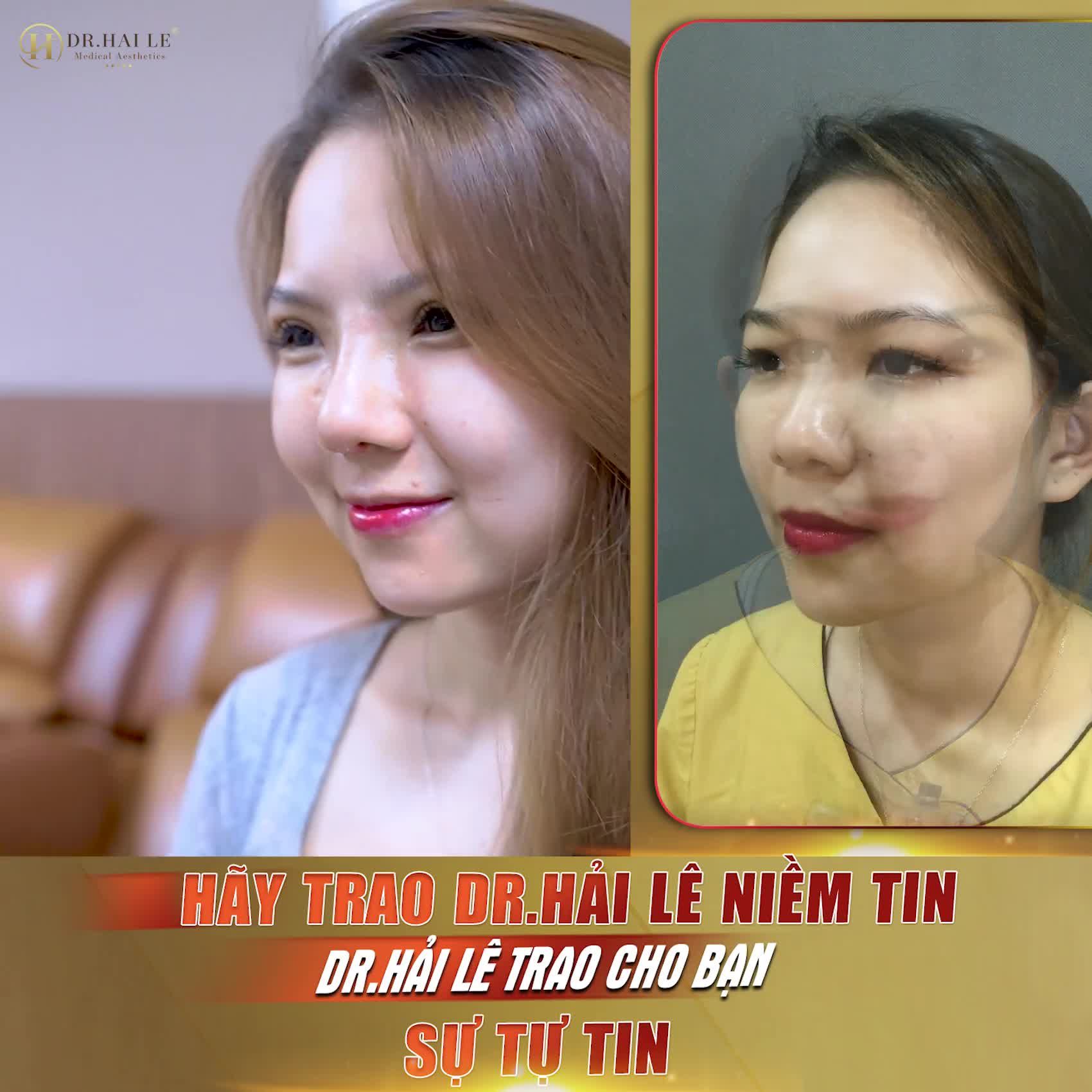 "Siêu phẩm" Cắt mí Nâng mũi 10 ngày xuất sắc tại Dr.Hải Lê, trời ơi siêu đẹp, siêu sang luôn đó ạ