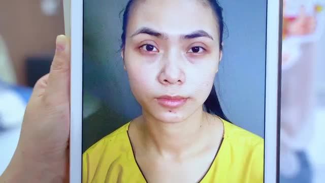 Sau 7 ngày Sửa mí vẫn còn sưng nề nhưng đã cải thiện cơ bản tình trạng mí lỗi hỏng nặng