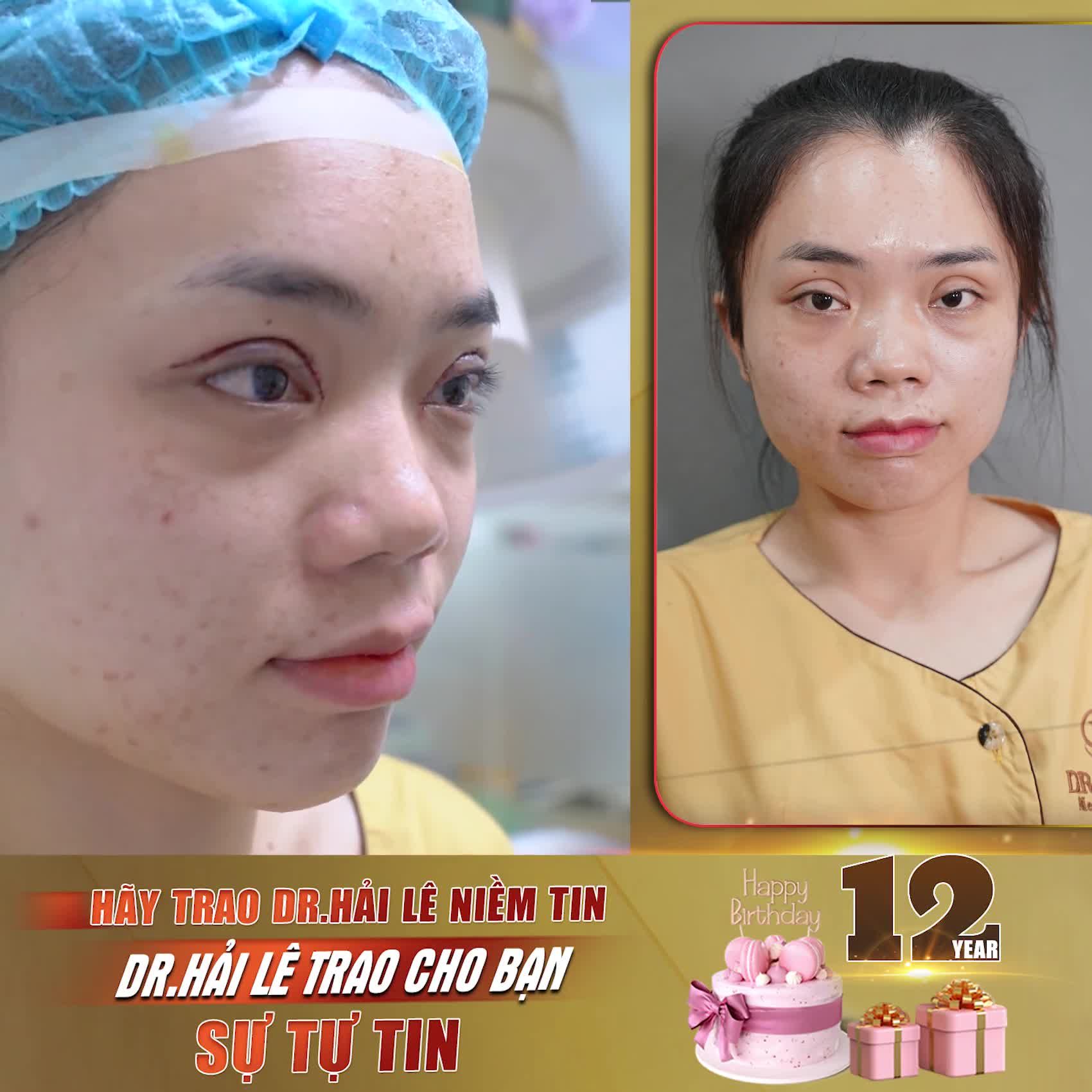 "Sửa mí xong nhẹ hẳn người' "Nếu không sửa mí ở Dr.Hải Lê, thì không biết sửa ở đâu"