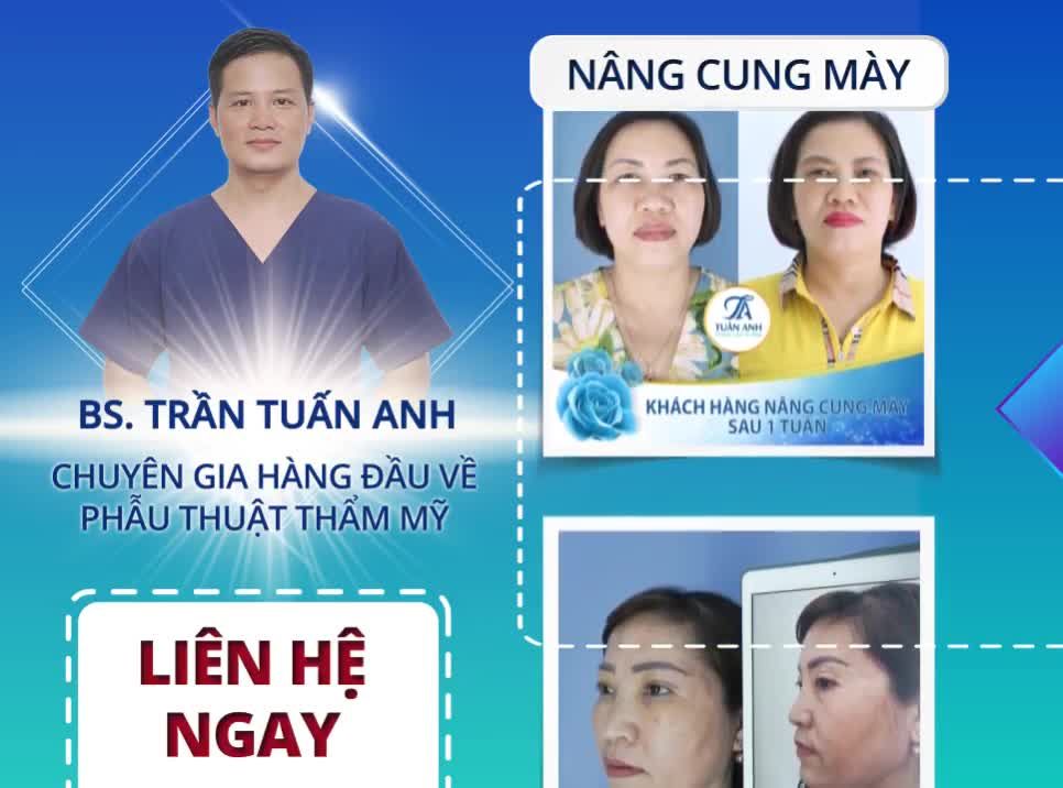 Nâng Cung Mày phù hợp với khách hàng nào