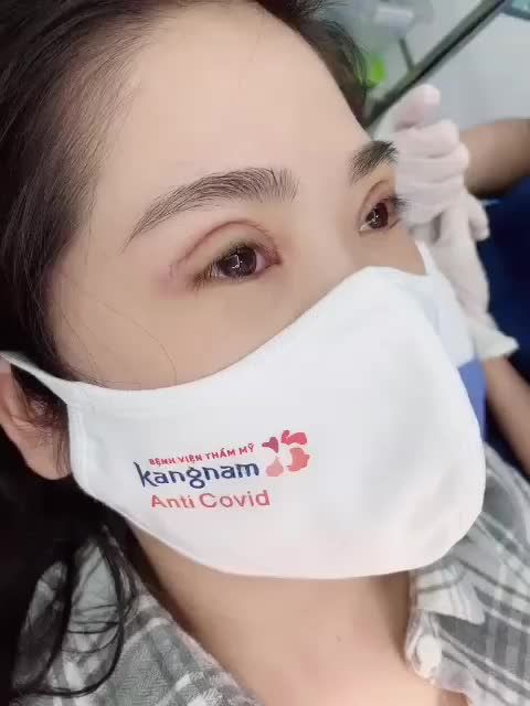 Quy trình cắt chỉ mí sau 5 ngày với dịch vụ cắt mí Plasma