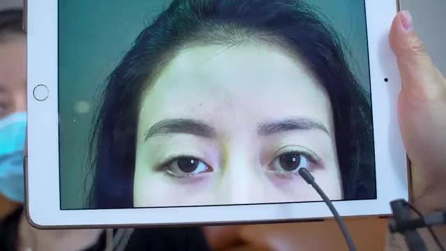 Nhược cơ nâng mi gây sụp mí, mắt không đều được khắc phục đẹp như thế nào sau khi trải nghiệm dịch vụ tại Dr.Hải Lê Top 1 cắt mí
