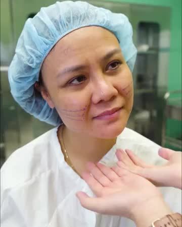 TƯ VẤN CĂNG CHỈ TRẺ HÓA CHO CHỊ KHÁCH U35