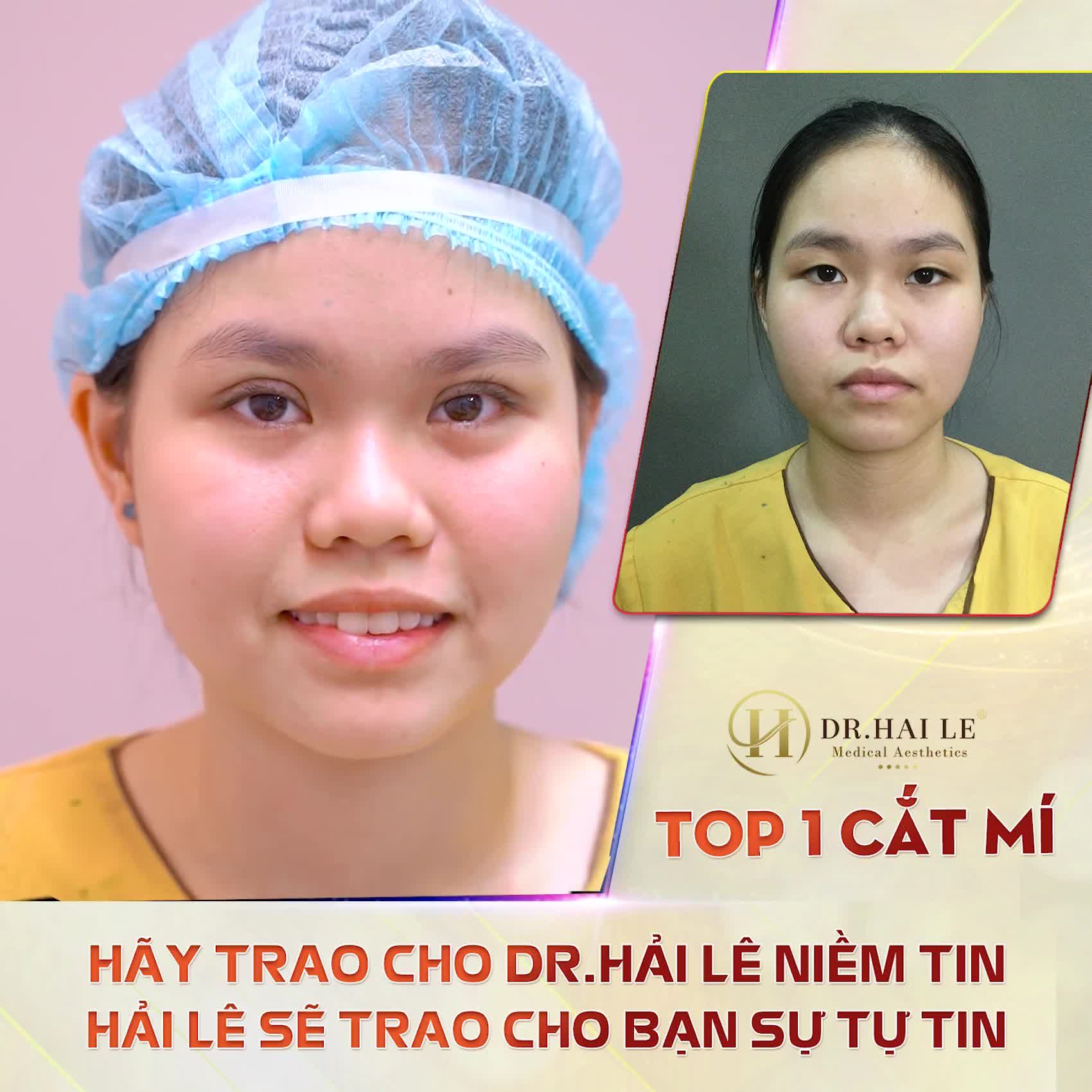 DR.HẢI LÊ - TOP 1 CẮT MÍ