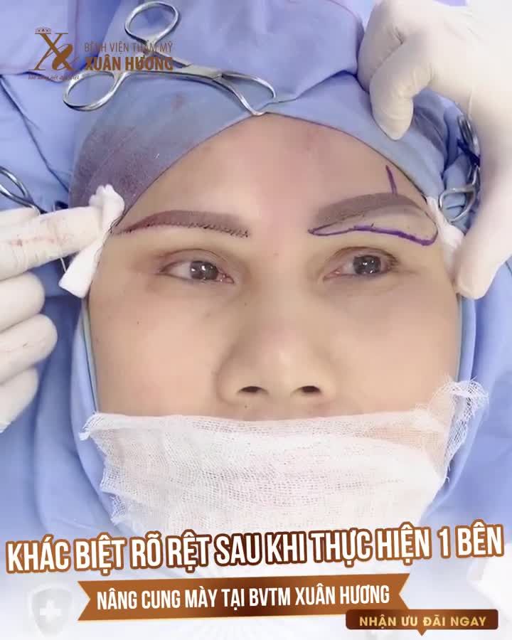 NÂNG CUNG MÀY ĐEM LẠI HIỆU QUẢ TRẺ HÓA NHƯ THẾ NÀO?