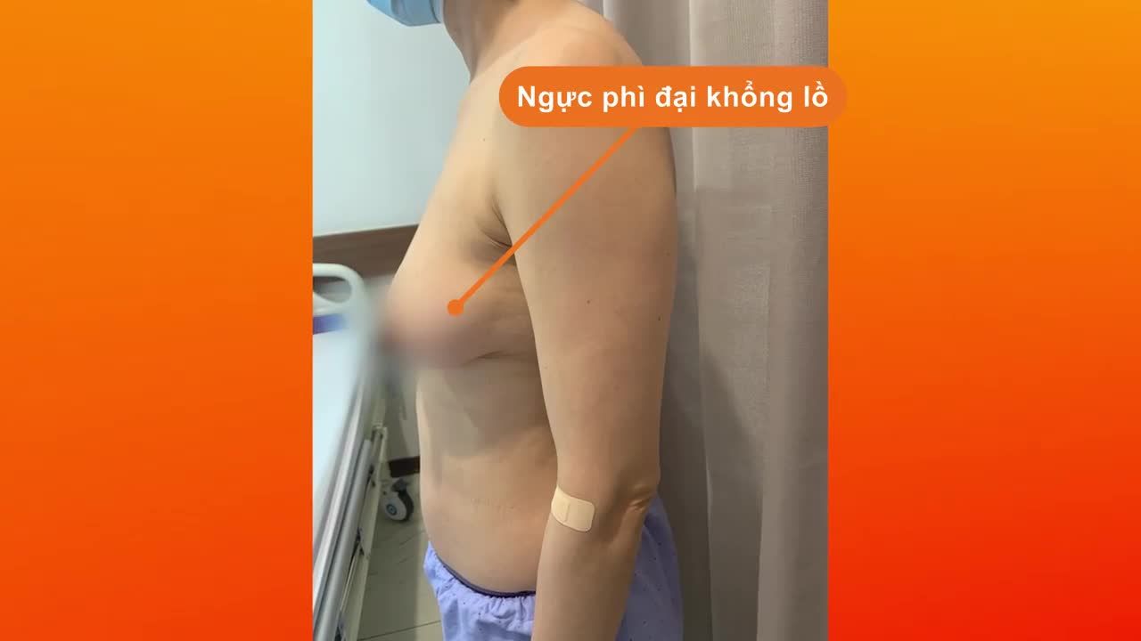 Thu ngực phì đai + Treo ngực sa trễ độ 4 có khó khăn, có đau như bạn nghĩ?
