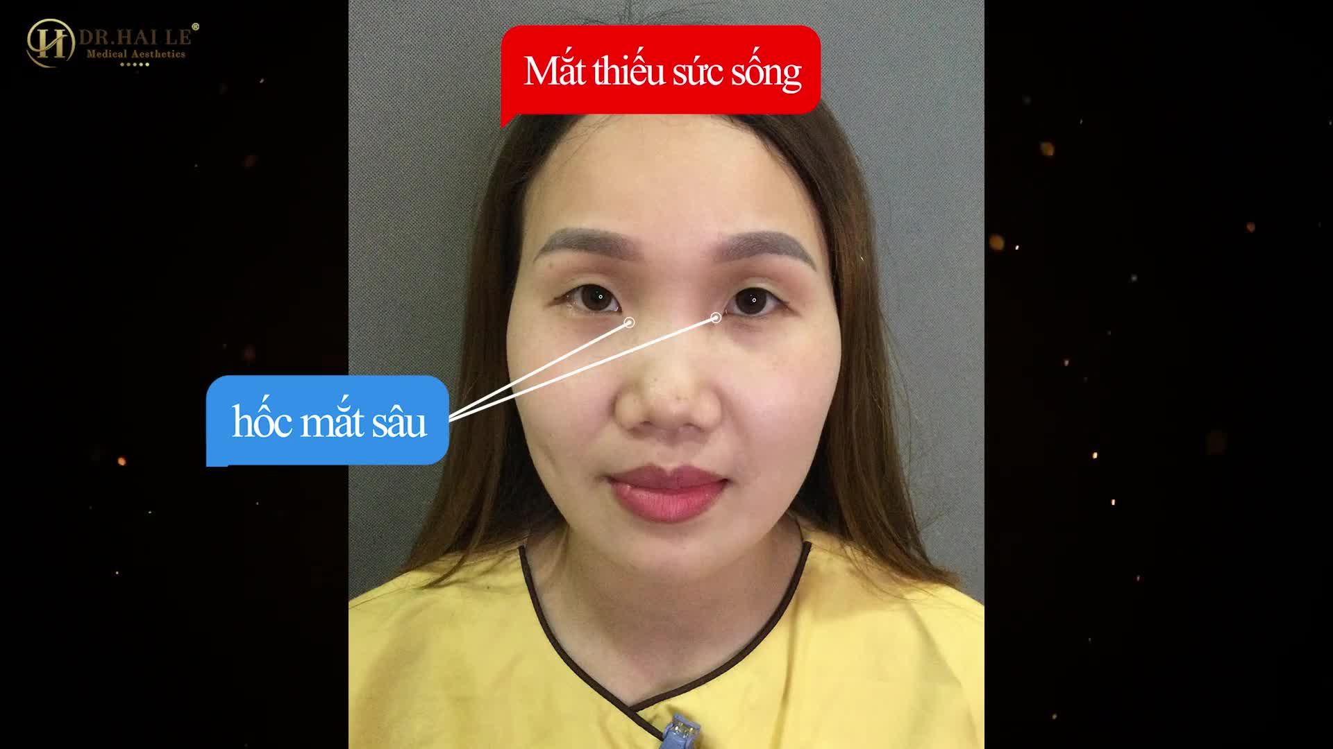 "Lúc em đi cắt mí, chồng ngăn cản vì làm xong sợ không đẹp, thấy trên mạng nhiều ca mí làm xong lỗi, hỏng khiếp lắm"