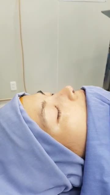 Kết quả sau phẫu thuật Nâng mũi 100% sụn tự thân
