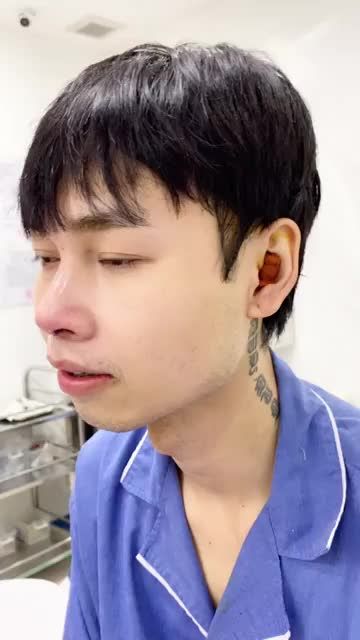 Khách hàng nam ngay sau 45 phút nâng mũi tại Kangnam