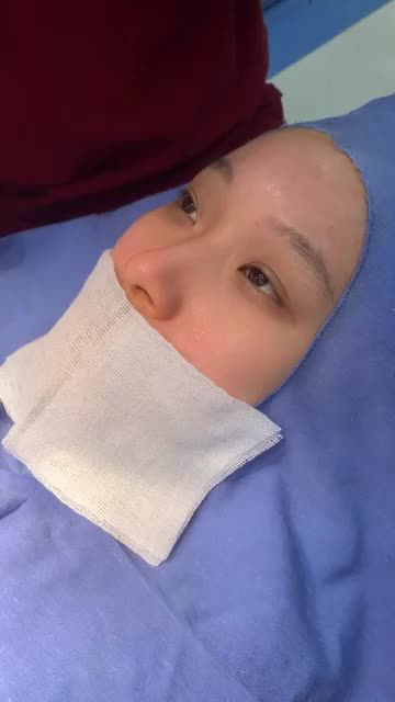 Quá trình đo vẽ ca Cắt mí Plasma thứ 15 trong ngày