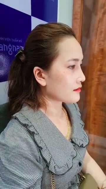 Mũi cao thanh tú với dịch vụ nâng mũi sline 4d - Tưng bừng giảm giá ngày vàng 26-28/11 này