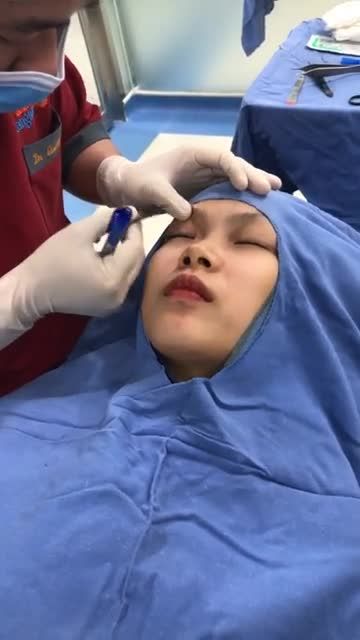 Quy trình đo vẽ cắt mí tại BVTM kangnam