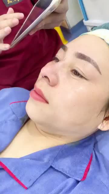 Kết quả nâng mũi Cấu trúc 4D tại Kangnam Hà Nội Nâng mũi xong vừa xinh vừa sang hơn hẳn cả nhà ơi