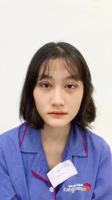 Kết quả Phẫu thuật cắt mí tại BVTM KANGANM