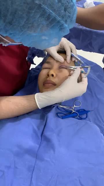 Combo Cắt mí + Tạo hình môi Bộ đôi hoàn hảo cho nữ khách hàng