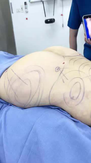 Ai bảo hõm mông không khắc phục được thì tới Kangnam nhé