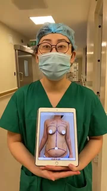 HÌNH ẢNH TRƯỚC PHẪU THUẬT CỦA KHÁCH HÀNG SỬ DỤNG COMBO NÂNG CẤP VÒNG 1 VÀ THON GỌN VÒNG 2