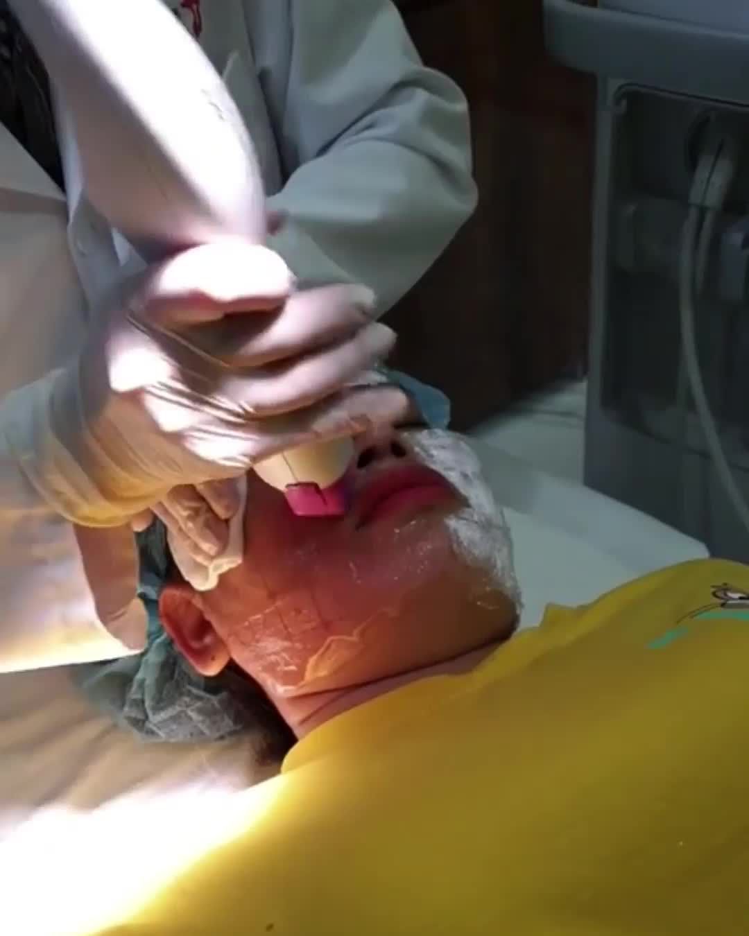 Ca Trẻ hoá bằng Thermage FLX thứ 3 trong ngày !!