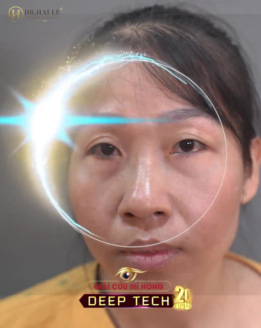 Chị ấy đã trở lại và lợi hại hơn xưa sau khi sửa mí tại Dr.Hải Lê