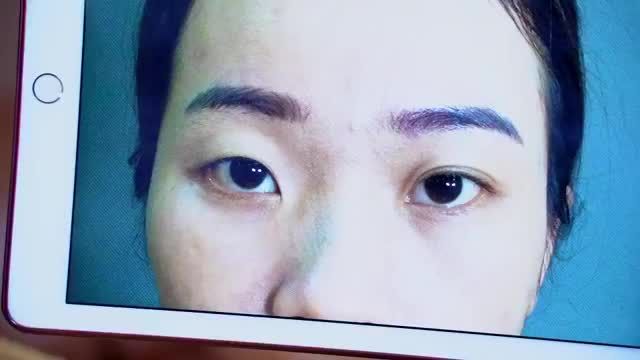 Dr.Hải Lê Top 1 Cắt mí đã giúp em gái sở hữu đôi mắt đẹp tự nhiên như thế nào? Mời cả nhà cùng đón xem