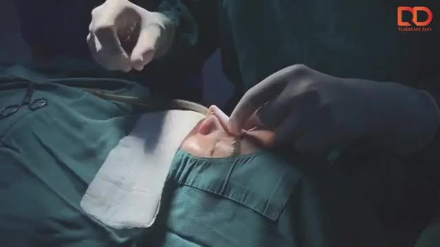 Kết quả sau 30 phút thực hiện nâng mũi sline cho khách hàng.