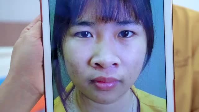 Mắt sụp mí, bọng mỡ mí mắt có khắc phục được sau Cắt mí không? Mời cả nhà cùng theo dõi