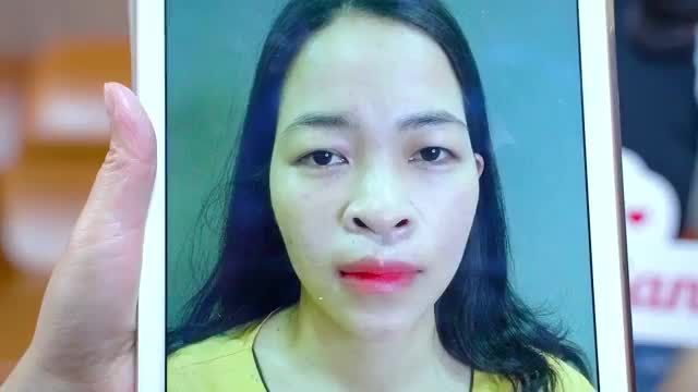 Mắt sụp mí u buồn phương pháp nào có thể cải thiện? Đến Dr.Hải Lê Top 1 thẩm mỹ mắt bạn sẽ nhận được kết quả ngoài cả sự mong đợi