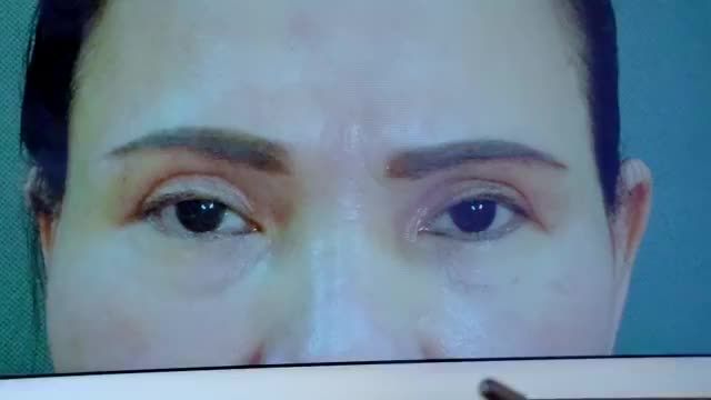 Mí mắt lỗi hỏng bạn đừng quá lo lắng hãy đến Dr.Hải Lê trao niềm tin cho bác sĩ Bác sĩ sẽ trao cho bạn sự tự tin