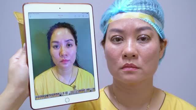 Mí trót cắt lỗi hỏng tại cơ sở thiếu uy tín có sửa lại được không? và kết quả sau khi sửa mí Deep Tech20 của chị khách hàng dưới đây chính là câu trả lời của Dr.Hải Lê