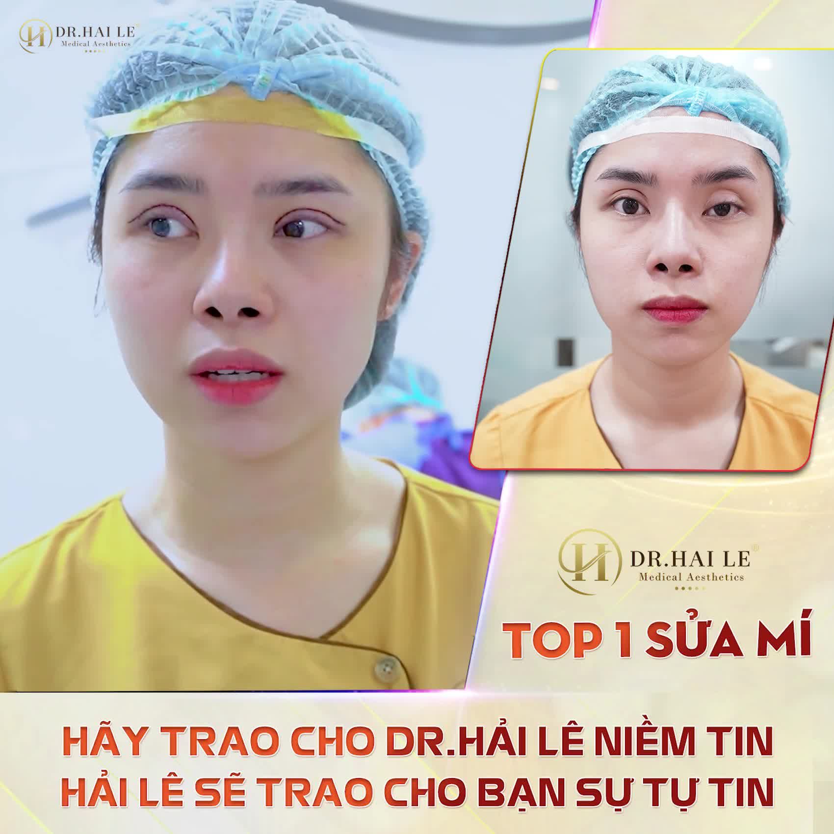 Review kết quả sửa mí "chất như nước cất" từ chính người trong cuộc.