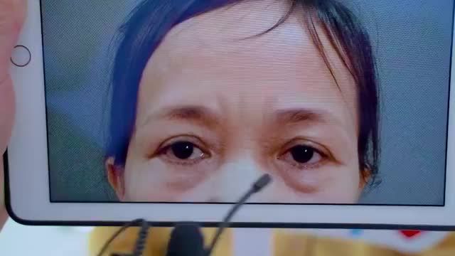 "Tôi không nghĩ cải thiện được sụp mí bọng mỡ nhiều như vậy cho đến khi Tôi đến Dr.Hải Lê"