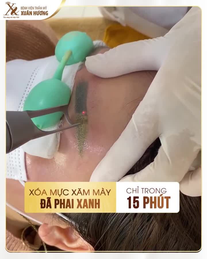 XÓA MỰC XĂM MÀY PHAI XANH CHO KHÁCH HÀNG NAM CHỈ 15 PHÚT