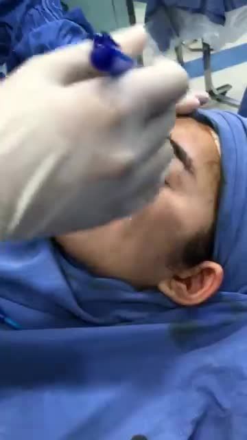 Phân tích phâu thuật nâng mũi cấu trúc 4D cho xô gái 20t lần đầu đi phẫu
