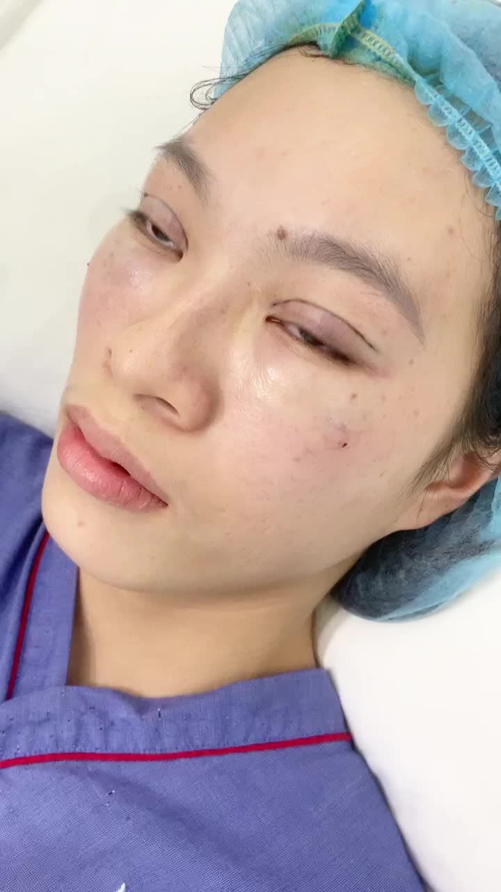 Mắt xinh kịp Tết, nữ khách hàng tới Kangnam thực hiện Combo Bấm mí + Cấy mỡ mắt