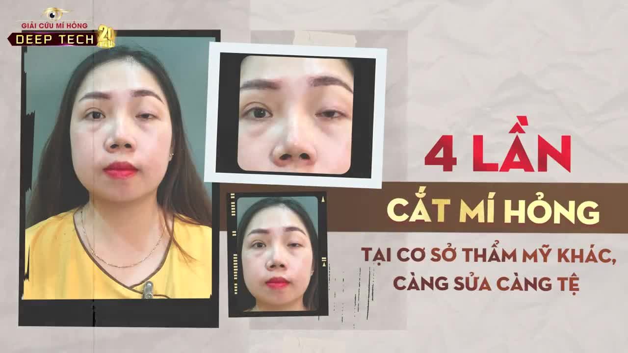 Bạn ấy nói "Họ không có kinh nghiệm, cắt mí bóc tách mỡ, cắt đứt luôn cả cơ nâng mi"