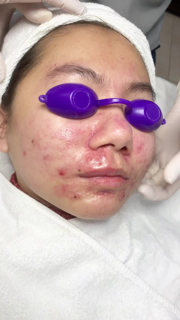 Đau đớn vì mụn viêm nặng lâu năm chưa nơi nào chữa khỏi