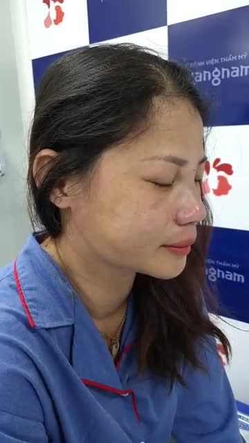 Lột xác với dịch vụ nâng mũi cấu trúc kết hợp cắt cánh mũi tại BVTM Kangnam Sài Gòn 666 Cạch Mạng Tháng 8