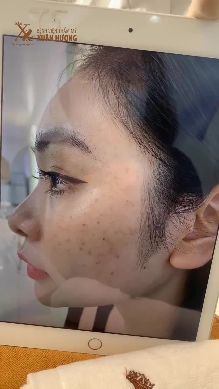 CẤP ẨM HA PHỤC HỒI DA SAU KHI TRỊ TÀN NHANG, DA CĂNG BÓNG SÁNG KHỎE