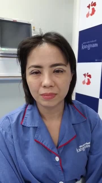 Khách hàng cắt mí plasma rất thành công tại bệnh viện thẩm mỹ Kangnam Sài Gòn