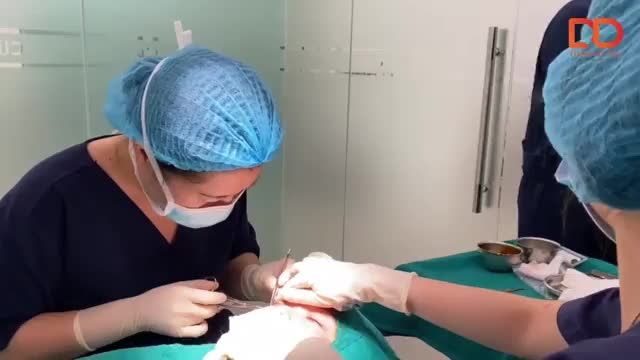 Khách hàng thực hiện cắt mí dưới Elite Eyes loại bỏ bọng mắt, da thừa tại Thẩm mỹ DrD.